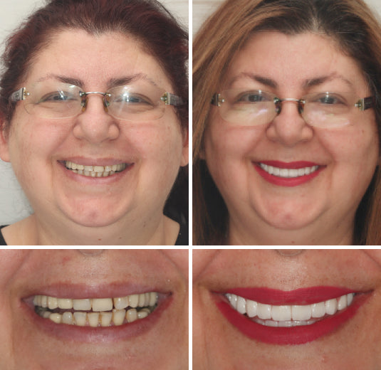 Cromos | HZA™ – Prothèse dentaire complète sur mesure pour un sourire naturel