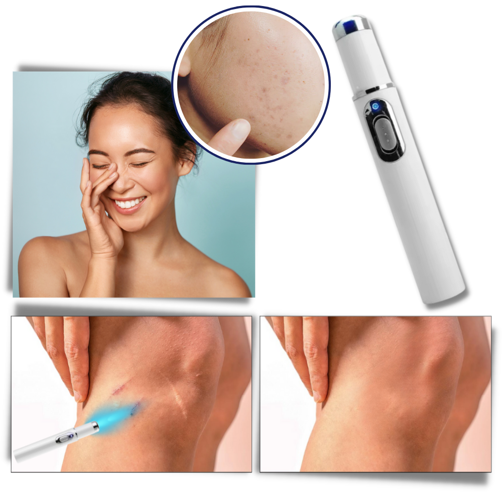 Cromos | Thérapie Laser Portable pour une Peau Éclatante – DermaPure