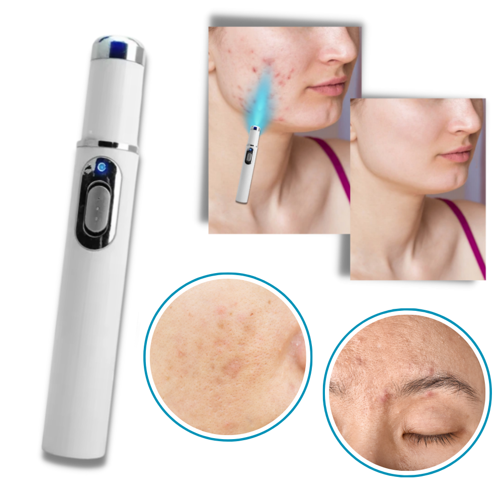 Cromos | Thérapie Laser Portable pour une Peau Éclatante – DermaPure